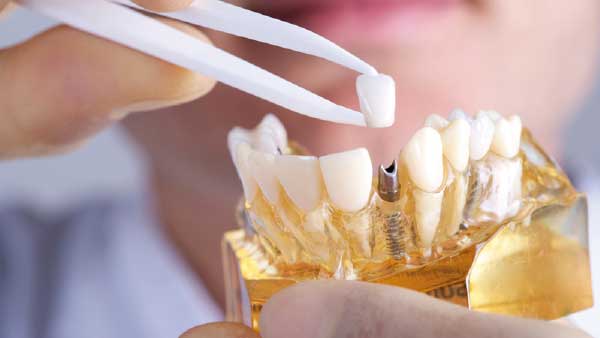 Implantes Dentales en Torrejón de Ardoz